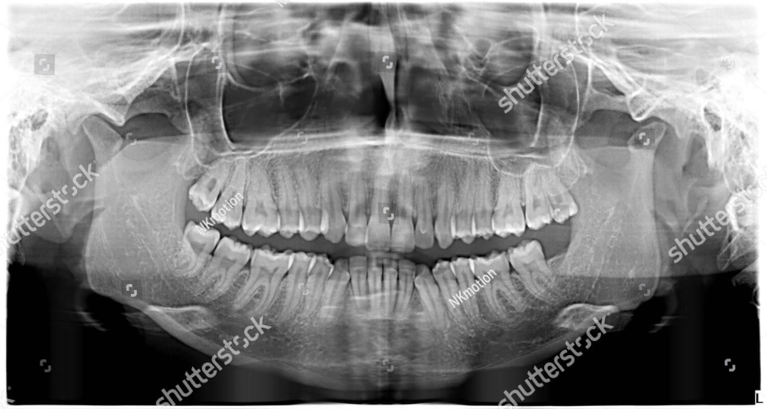 Panoramic dental X-ray showing wisdom teeth